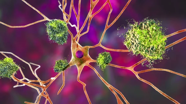 Neurons in Alzheimer\'s disease. 3D illustration showing amyloid plaques in brain tissue, neurofibrillary tangles and distruction of neuronal networks