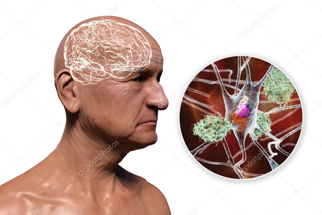 Dementia, conceptual 3D illustration showing an elderly person with progressive impairments of brain functions, amyloid plaques in brain, neurofibrillary tangles and distruction of neuronal networks