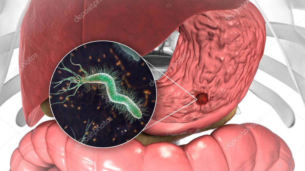 Stomach ulcer and closeup view of bacteria Helicobacter pylori, associated with ulcer formation, 3D illustration