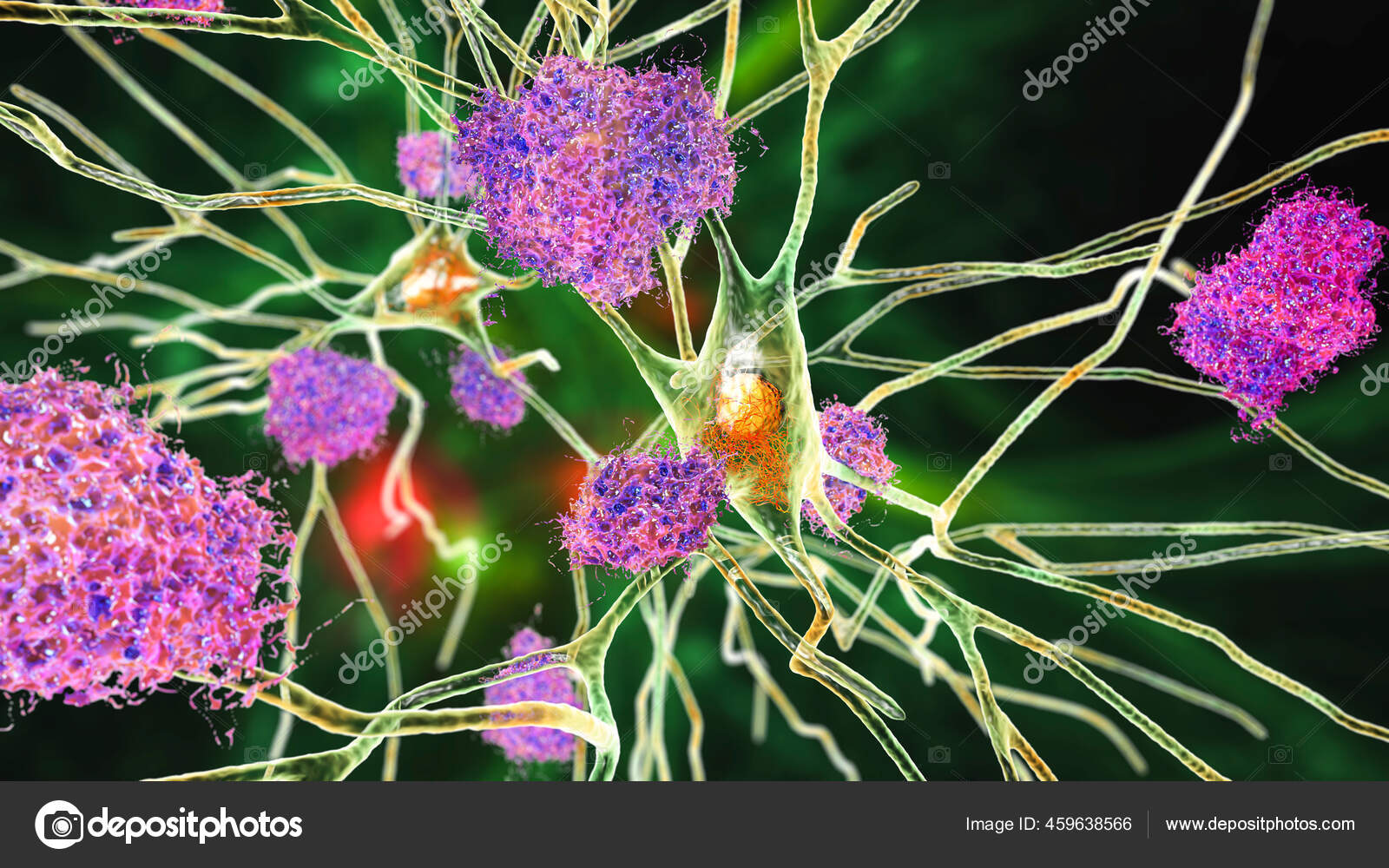 Neurons Alzheimer's Disease Illustration Showing Amyloid Plaques Brain Tissue Neurofibrillary