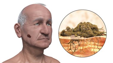 Melanoma, a cancer developing from pigment-containing cells melanocytes, 3D illustration showing melanoma on the face and close-up view of cancer invasion clipart