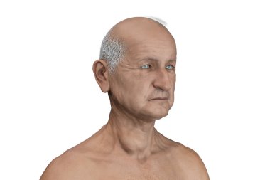 Tiroid kanseri, tiroid bezinde tümör olduğunu gösteren 3 boyutlu illüstrasyon.