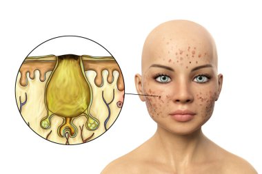 Akne vulgaris, ölü deri hücreleri ve cilt tıkanması kıl foliküllerinden çıkan yağ, genç bir kızın 3 boyutlu çizimi ve akne siyahi komedyeninin yakın çekim görüntüsü sonucu oluşan bir cilt rahatsızlığı.