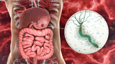 Stomach ulcer and closeup view of bacteria Helicobacter pylori, associated with ulcer formation, 3D illustration clipart