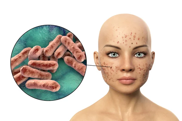 皮膚上のにきびのハゲワシや細菌のクローズアップビュー キューティビズムにきび 以前は にきびの開発 3Dイラストに関連付けられているプロピオンビズムにきび — ストック写真
