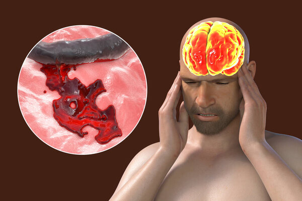 Stroke, conceptual 3D illustration showing a man with acute headache and rupture of brain blood vessel