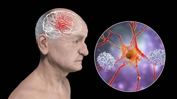 Dementia, conceptual 3D illustration showing an elderly person with progressive impairments of brain functions, amyloid plaques in brain, neurofibrillary tangles and distruction of neuronal networks