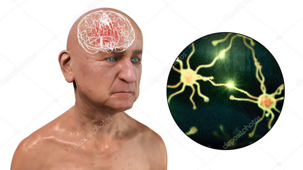 Dementia, conceptual 3D illustration showing an elderly person with progressive impairments of brain functions, distruction of neurons and their networks