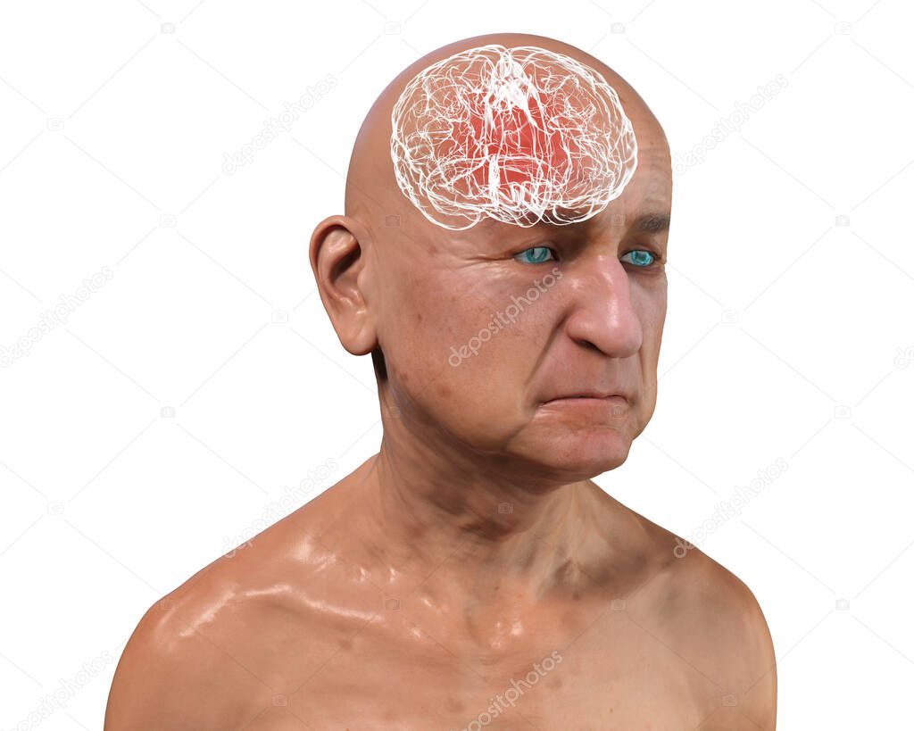 Dementia, conceptual 3D illustration showing an elderly person with progressive impairments of brain functions