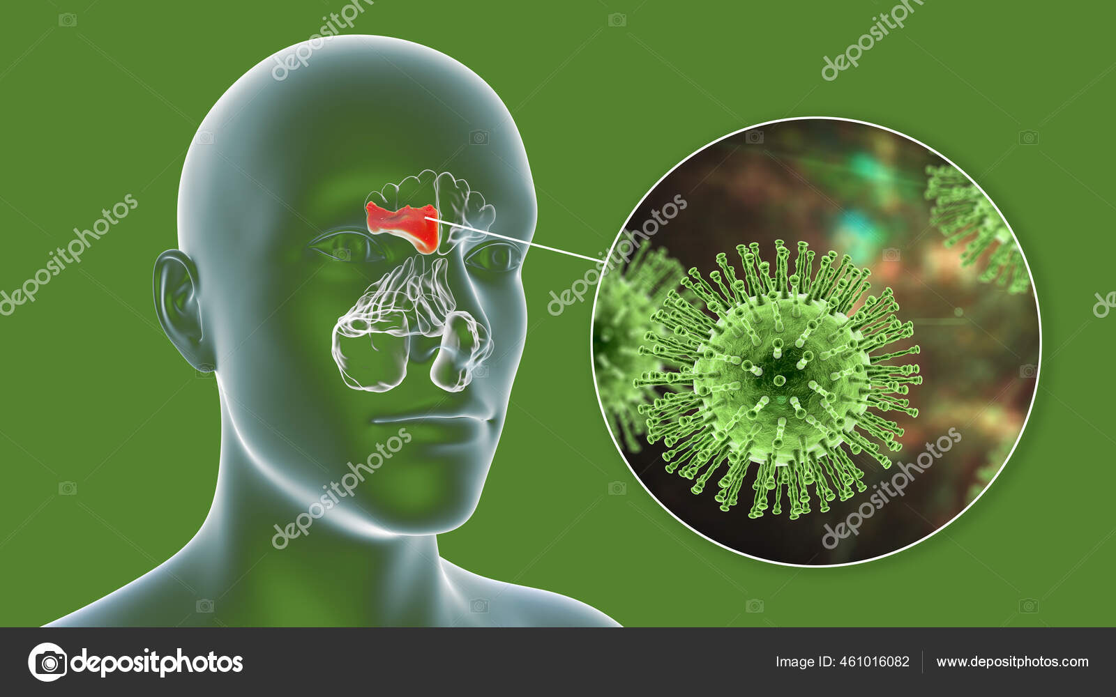 Viral Sinusitis Inflammation Paranasal Cavities Illustration Showing