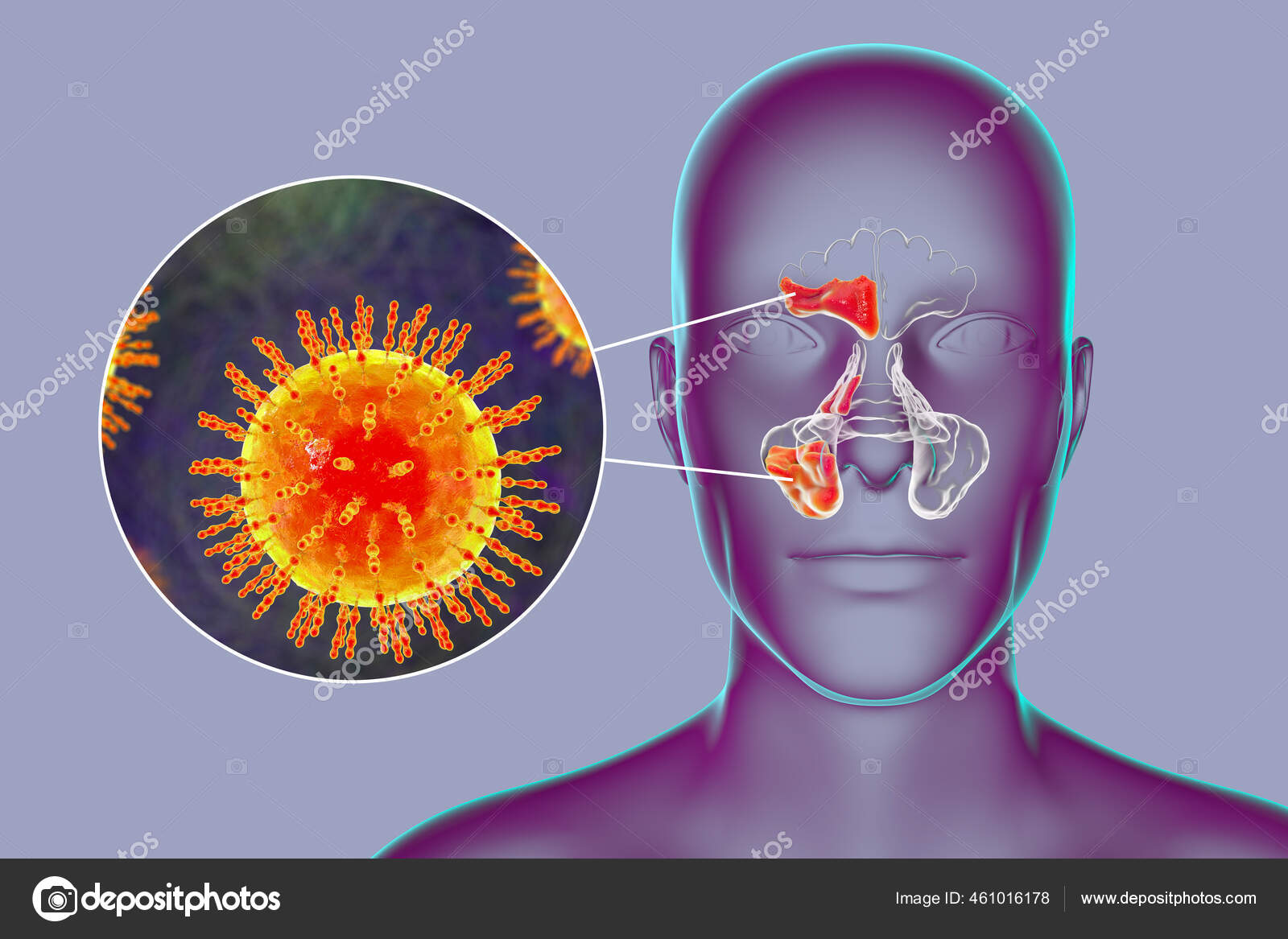 Viral Sinusitis Inflammation Paranasal Cavities Illustration Showing Inflammation Frontal Sinus