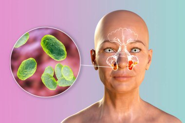 Sinüzitin nedeni olarak hemofili gribi bakterisi. Maksimum sinüslerde iltihaplanma ve Haemophilus bakterisinin yakın çekim görüntüsünü gösteren 3 boyutlu illüstrasyon