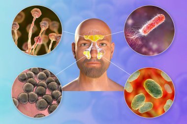 Sinüzit, mantar Aspergillus, bakteri Pseudomonas aeruginosa, Streptococcus pneumoniae ve Haemophilus influenzae 'ye neden olan mikroorganizmalar, 3 boyutlu illüstrasyon