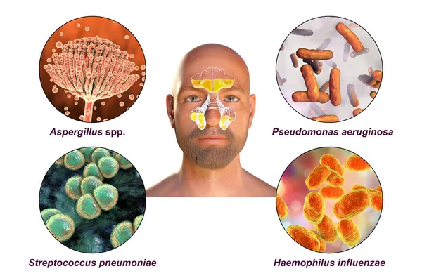 Nosinuit Och Mikroorganismer Som Orsakar Sinuit Svampar Aspergillus Bakterier Pseudomonas — Stockfoto
