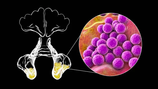 Staphylococcus Aureus Bacteria Mrsa Como Causa Sinusitis Ilustración Que Muestra — Foto de Stock