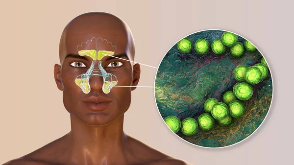 Streptococcus Pyogenes Bacteria Other Streptococci Cause Sinusitis Ilustrace Zánětu Čelních — Stock fotografie