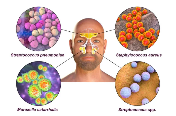 Nosinuit Hos Människa Och Bakterier Som Orsakar Sinuit Streptococcus Pneumoniae — Stockfoto