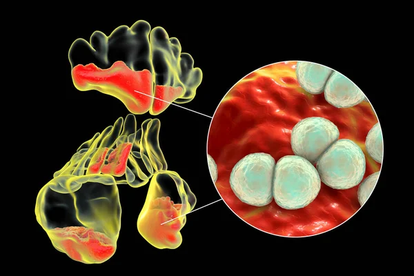 肺炎链球菌是引起鼻窦炎的原因之一 三维图显示额窦 上颌窦 筛窦的脓性炎症及肺炎球菌近视 — 图库照片