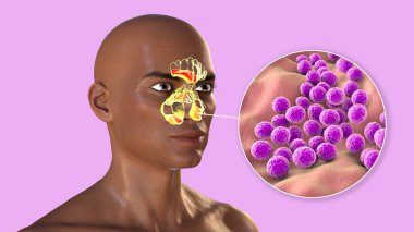 Sinüzitin nedeni olarak Stafilokok aureus bakterisi. 3 boyutlu illüstrasyon, Afrikalı bir erkekte frontal sinüslerde iltihaplanma ve staphylococci bakterilerin yakın çekim görüntülerini gösteriyor.