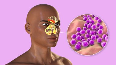 Staphylococcus aureus bacteria as a cause of sinusitis. 3D illustration showing purulent inflammation of frontal sinuses in an African man and close-up view of staphylococci bacteria clipart