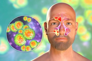 Moraxella catarrhalis bacteria as a cause of sinusitis. 3D illustration showing purulent inflammation of frontal and maxillary sinuses and close-up view of Moraxella bacteria clipart