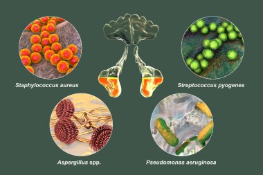 Anatomy of rhinosinusitis and bacteria that cause sinusitis Staphylococcus aureus, Streptococcus pyogenes, Aspergillus fumigatus, and Pseudomonas aeruginosa, labelled 3D illustration clipart