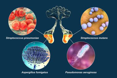 Sinüzit Streptococcus pneumoniae, Streptococcus mutans, Aspergillus fumigatus ve Pseudomonas aeruginosa 'ya neden olan rinosinusit ve mikroorganizmaların anatomisi, 3 boyutlu illüstrasyon olarak etiketlenmiştir.