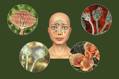 Sinüzitin sebebi mantarlar. Üst çene sinüsleri ve mantar Aspergillus, Penisilyum, Mucor ve Candida iltihaplanmalarını gösteren 3 boyutlu illüstrasyon. İmmün yetmezliği olan hastalarda kronik mantar sinüziti