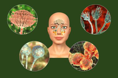 Fungi as a cause of sinusitis. 3D illustration showing inflammation of maxillary sinuses and fungi Aspergillus, Penicillium, Mucor and Candida. Chronic fungal sinusitis in immunocompromised patients clipart