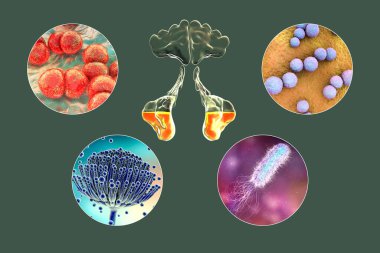 Anatomy of rhinosinusitis and microorganisms that cause sinusitis Streptococcus pneumoniae, Streptococcus mutans, Aspergillus fumigatus, and Pseudomonas aeruginosa, 3D illustration clipart