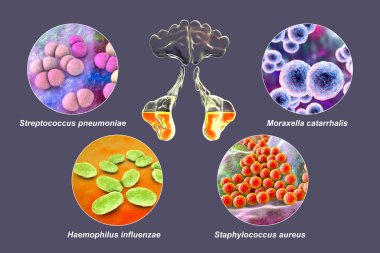 Sinüzit Streptococcus pneumoniae, Moraxella catarrhalis, Haemophilus influenzae ve Staphylococcus aureus 'a neden olan rinosinusit ve bakteri anatomisi.