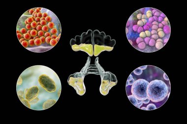 Sinüzit Staphylococcus aureus, Streptococcus pneumoniae, Haemophilus influenzae ve Moraxella catarrhalis 'e neden olan rinosinusit ve bakteri anatomisi.