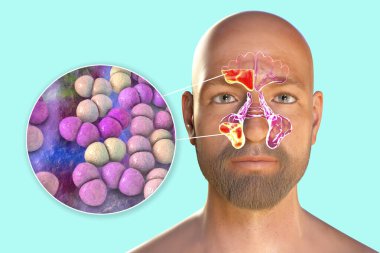 Staphylococcus aureus bakterisi, sinüzitin sebebi MRSA. 3 boyutlu illüstrasyon frontal ve maxillary sinüslerde iltihaplanma ve staphylococcal bakterilerin yakın çekim görüntülerini gösteriyor.
