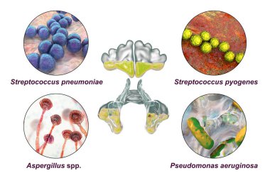 Sinüzit bakterisi Streptococcus pneumoniae, Streptococcus pyogenes, mantar Aspergillus, Pseudomonas aeruginosa, 3 boyutlu illüstrasyon etiketli bakterilerin anatomisi ve mikroorganizmaların