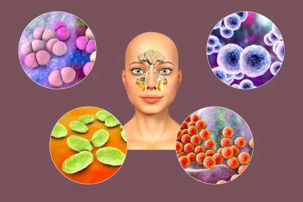 Anatomía Rinosinusitis Bacterias Que Causan Sinusitis Streptococcus Pneumoniae Moraxella Catarrhalis —  Fotos de Stock