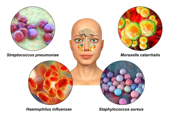 Anatomy Rhinosinusitis Bacteria Cause Sinusitis Streptococcus Pneumoniae Moraxella Catarrhalis Haemophilus — Stock Photo, Image