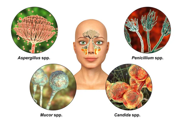 Svamp Som Orsak Till Bihåleinflammation Illustration Som Visar Inflammation Bihålorna — Stockfoto