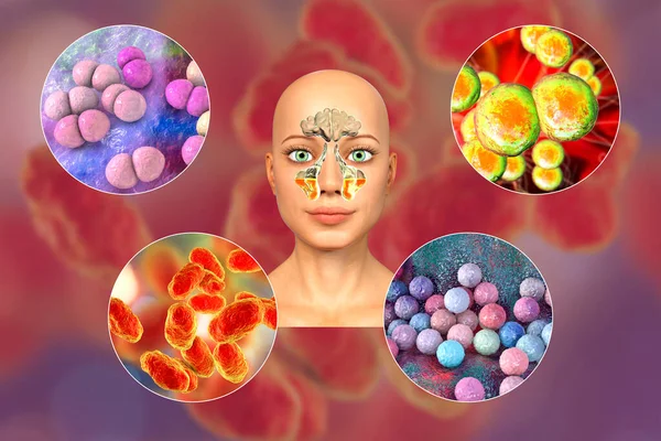 Anatomie Rhinosinusite Des Bactéries Responsables Sinusite Streptococcus Pneumoniae Moraxella Catarrhalis — Photo