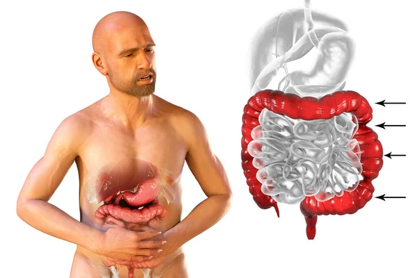 Dolor Abdominal Calambres Paciente Masculino Debido Síndrome Del Intestino Irritable — Foto de Stock