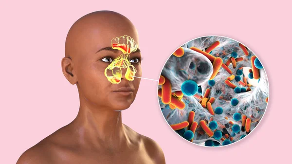 Sinuit Inflammation Paranasala Håligheter Illustration Visar Inflammation Främre Och Bakre — Stockfoto