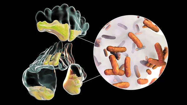 Bacteria Pseudomonas Aeruginosa Como Causa Sinusitis Ilustración Que Muestra Inflamación — Foto de Stock