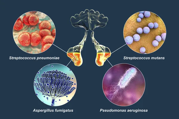 鼻窦炎和引起鼻窦炎链球菌肺炎的微生物的解剖 诱变链球菌 熏蒸曲菌和铜绿假单胞菌 标记为3D图例 — 图库照片