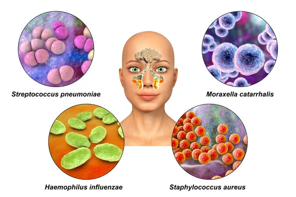 Anatomie Van Rinosinusitis Bacteriën Die Sinusitis Streptococcus Pneumoniae Moraxella Catarrhalis — Stockfoto