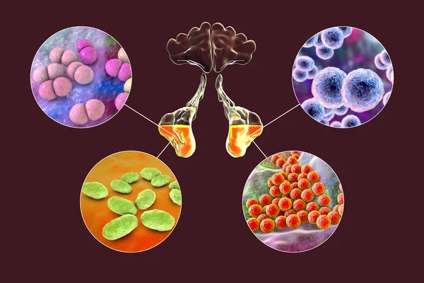 Anatomi Rinosinuit Och Bakterier Som Orsakar Sinuit Streptococcus Pneumoniae Moraxella — Stockfoto