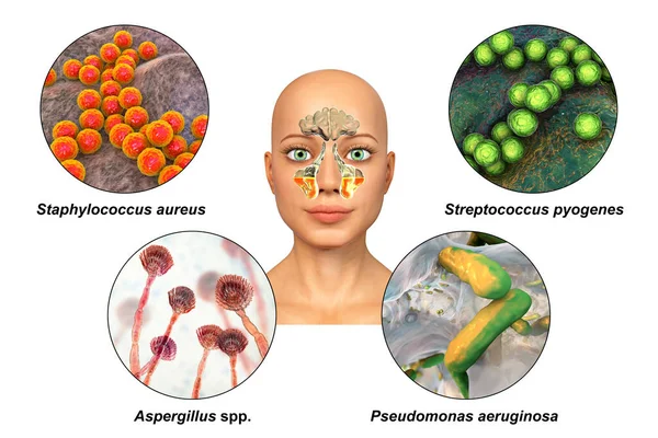 Anatomi Rinosinuit Och Bakterier Som Orsakar Sinuit Staphylococcus Aureus Streptococcus — Stockfoto