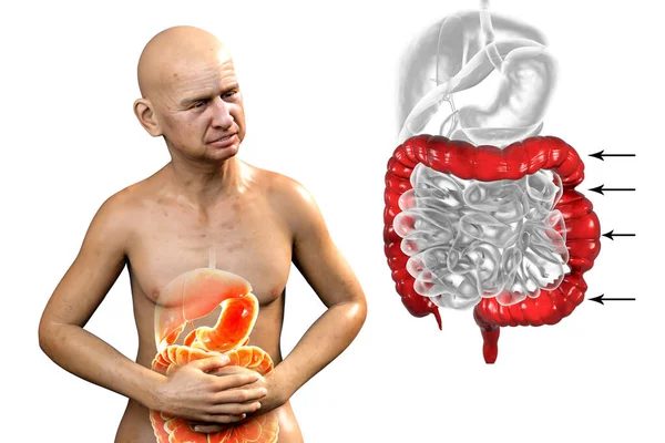 Dolor Abdominal Calambres Paciente Masculino Debido Síndrome Del Intestino Irritable — Foto de Stock