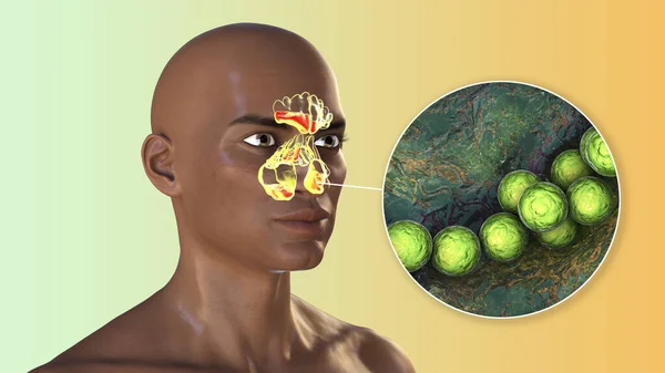 链球菌Pyogenes细菌和其他链球菌是引起鼻窦炎的原因之一 显示非洲男子额窦炎症及链球菌近视的3D图像 — 图库照片