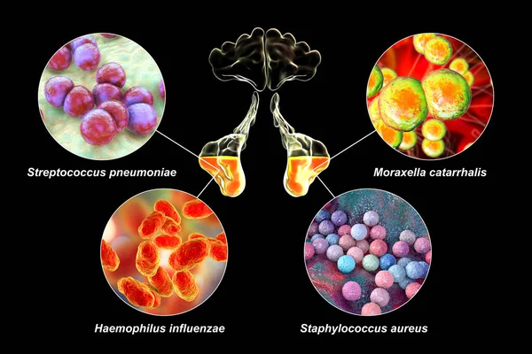 副鼻腔炎の原因となる鼻炎および細菌の解剖学的構造肺炎球菌 モラクセラ カタラーリス 血友病性インフルエンザ 黄色ブドウ球菌 3Dラベル付きイラスト — ストック写真