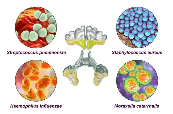Anatomi Rinosinuit Och Bakterier Som Orsakar Sinuit Staphylococcus Aureus Streptococcus — Stockfoto