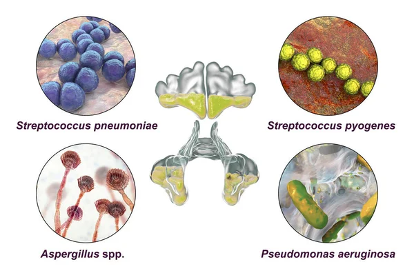 Anatomi Rinosinuit Och Mikroorganismer Som Orsakar Sinuit Bakterier Streptococcus Pneumoniae — Stockfoto